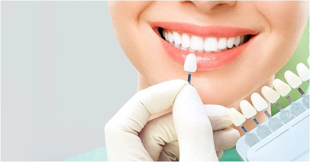 Blanqueamiento Dental