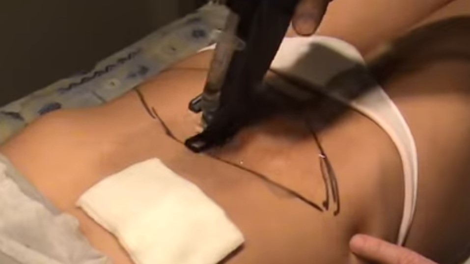 mesoterapia que inyectan
