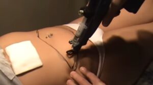 mesoterapia tratamiento