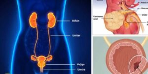 Enfermedades Urológicas Femeninas comunes